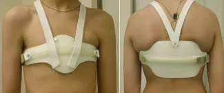 Pectus Carinatum brace