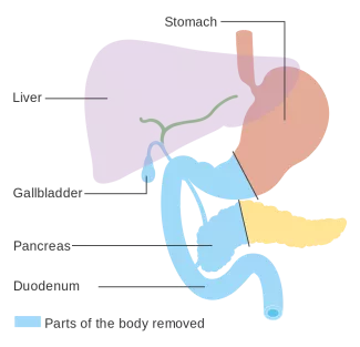 Diagram Showing The Parts Removed With A Whipples Operation CRUK 337Svg Diagram Showing The Parts Removed With A Whipples Operation CRUK 337Svg