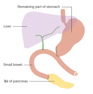 Diagram Showing How The Pancreas And Bowel Is Joined Back Together After A Whipples Operation CRUK 140Svg Diagram Showing How The Pancreas And Bowel Is Joined Back Together After A Whipples Operation CRUK 140Svg