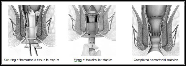 Procedure for Prapse and Hemorrhoids - Stapled